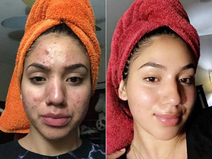 Jeloria Rice Peel Serum Ampoule™